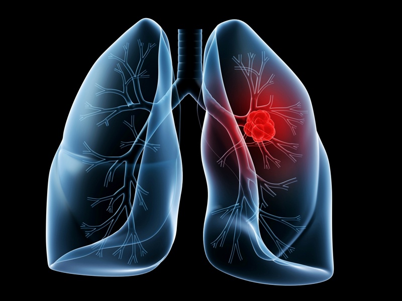 Черна статистика: Плевенчани на първите места по смъртност от рак на белите дробове