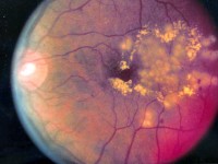 Днес е Световният ден за борба с глаукомата