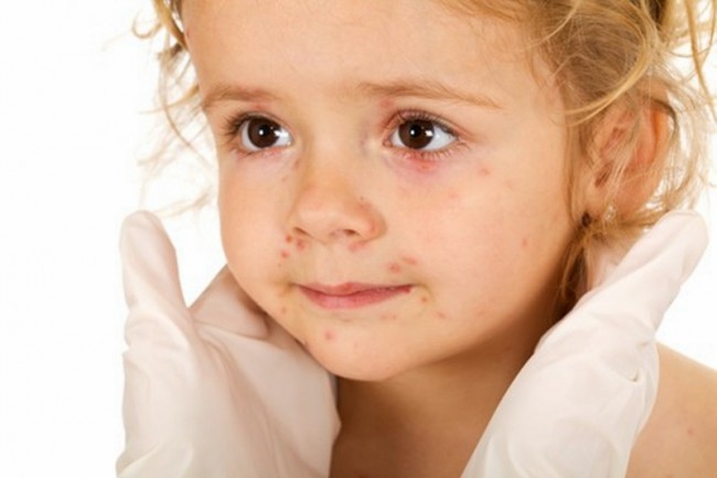 Стрептодермия фото у детей на теле