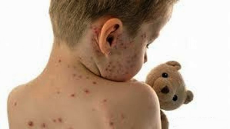 12 заболели от варицела в област Плевен за броени дни