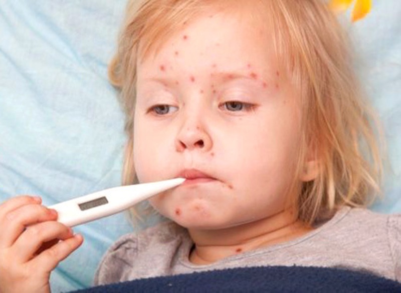 Нови случаи на варицела и скарлатина регистрирани за седмица в Плевенска област