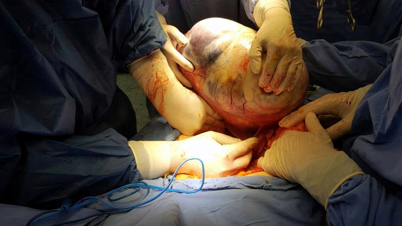 12-килограмов тумор извадиха от пациентка лекарите от екипа на проф. Горчев в МБАЛ „Света Марина“ – Плевен