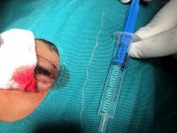 Лекари от Очна клиника към УМБАЛ „Д-р Георги Странски” – Плевен извадиха 10-сантиметров паразит от окото на пациент