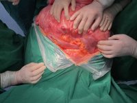 Гигантски 26 – килограмов тумор отстраниха хирурзи в плевенската УМБАЛ „Д-р Г. Странски“