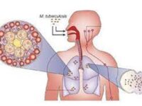 Прегледай се за туберкулоза в „Седмица на отворените врати“ в Плевен