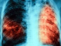 „УМБАЛ-Д-р Георги Странски“ ЕАД – Плевен с безплатна кампания „Отворени врати за оценка на риска от белодробна туберколоза“